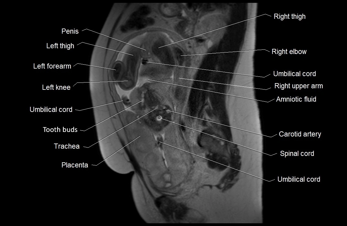 MRI fetal anatomy sagittal image 15.webp